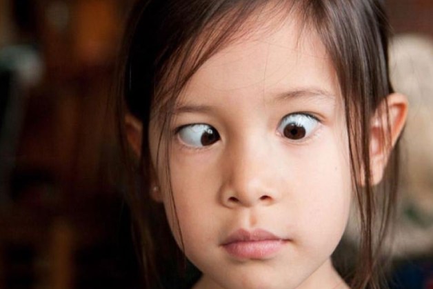 mắt bé bị lé