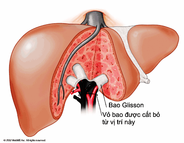 Mổ gan nội soi là phương pháp được sử dụng rộng rãi hiện nay