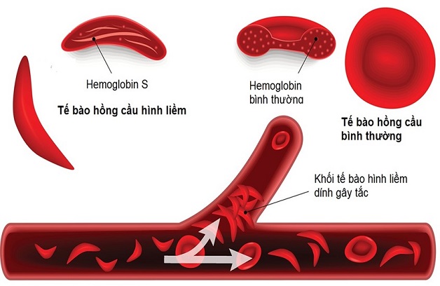 người trẻ đột quỵ do mắc bệnh hồng cầu hình liềm
