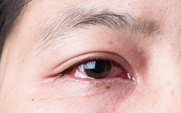 Hình ảnh đau mắt đỏ