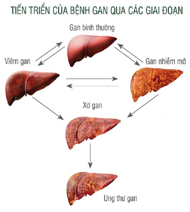 Xơ gan, ung thư gan phát triển từ