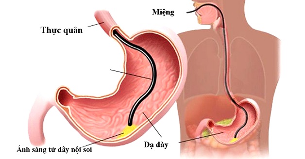 Nội soi là kỹ thuật chẩn đoán các bệnh ở hệ tiêu hóa