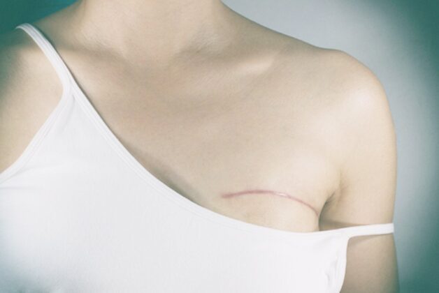 Tìm hiểu về phương pháp phẫu thuật trong điều trị ung thư vú