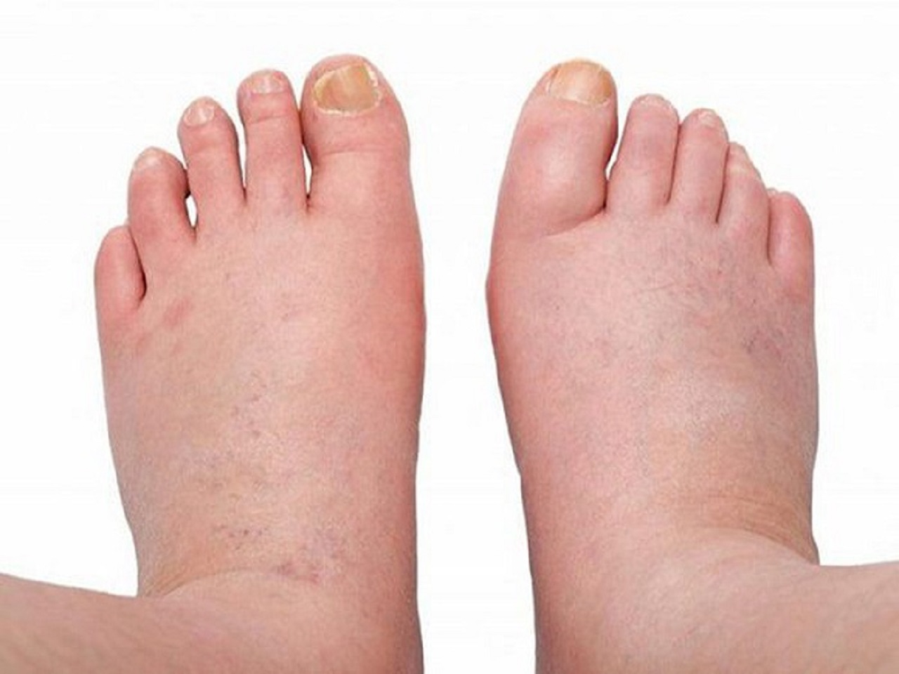 Phù xơ gan: Biến chứng thường gặp của ở người xơ gan