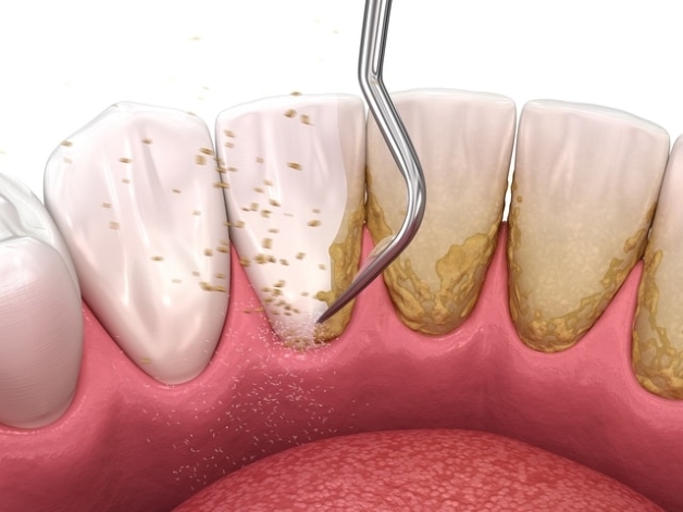 Răng sứ có phải cạo vôi răng không