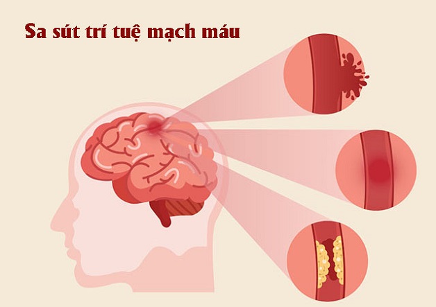 Sa sút trí tuệ sau đột quỵ là gì? Nguyên nhân