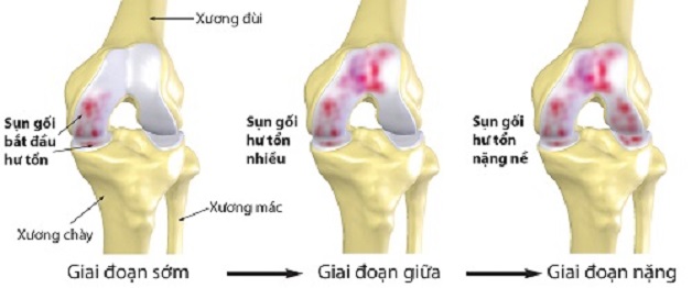 hình ảnh thoái hóa khớp là gì?