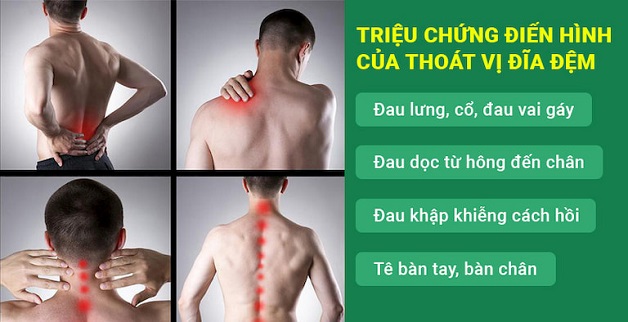Thoát vị đĩa đệm có nguy hiểm không? Dấu hiệu nhận biết