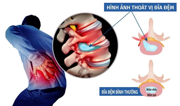 Thoát vị đĩa đệm có nguy hiểm không? Đối tượng dễ bị