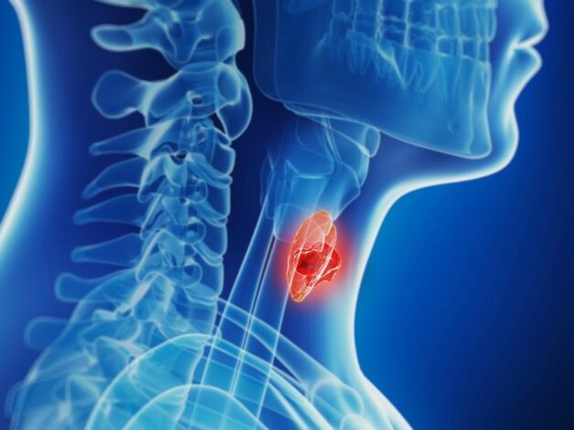 Nhân tuyến giáp tirads 3 lành tính và vẫn có nguy cơ nhỏ ác tính