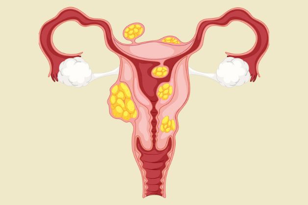 Giải đáp thắc mắc cho chị em mắc u xơ tử cung có uống được sâm Angela không