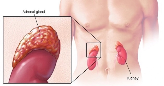Điều trị bệnh ung thư tuyến thượng thận gặp nhiều khó khăn vì phát hiện muộn.