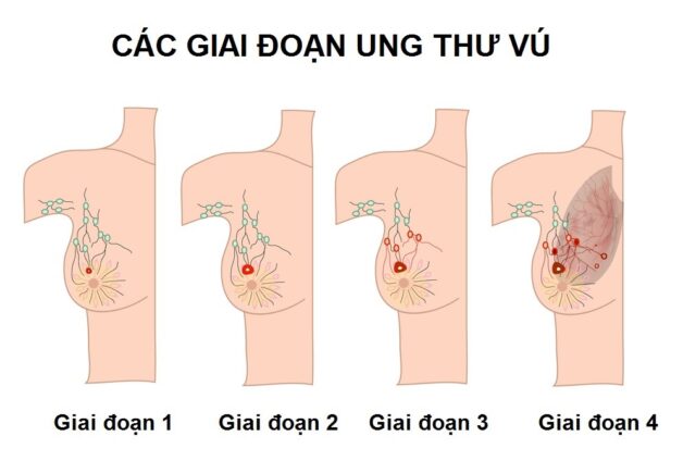 Quá trình u vú ác tính