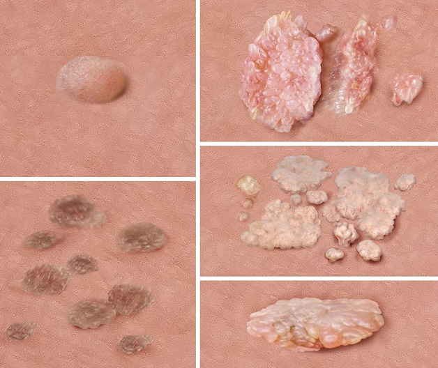 vacxin hpv cho nam giới