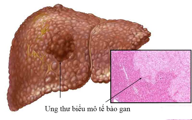 viêm gan B chuyển sang xơ gan, ung thư biểu mô tế bào gan