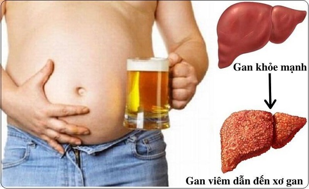 Bệnh viêm gan do rượu tác động xấu tới sức khỏe.