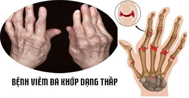 Viêm khớp dạng thấp bệnh học gì?