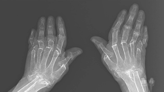 Cách trị viêm khớp dạng thấp hiệu quả hiện nay.