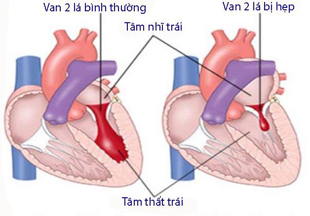 điều trị hẹp van tim 2 lá