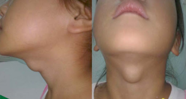 Sưng cổ là 1 trong 10 dấu hiệu tuyến giáp cần lưu ý