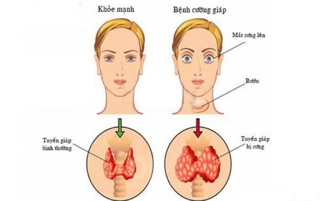 Cường giáp gây tăng cân