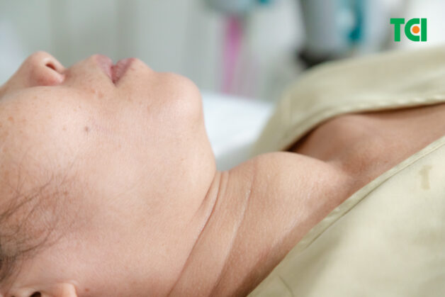 Khối bướu giáp lớn to như quả trứng vịt của bệnh nhân T. (Ảnh:TCI)