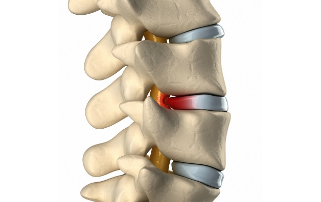 Thoát vị đĩa đệm gây hẹp ống sống theo cơ chế nào?