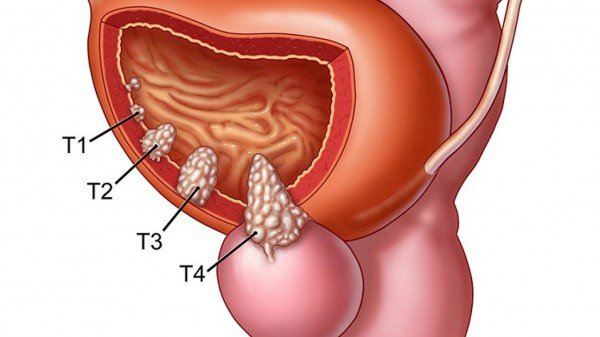 nguyên nhân gây bệnh ung thư tuyến tiền liệt