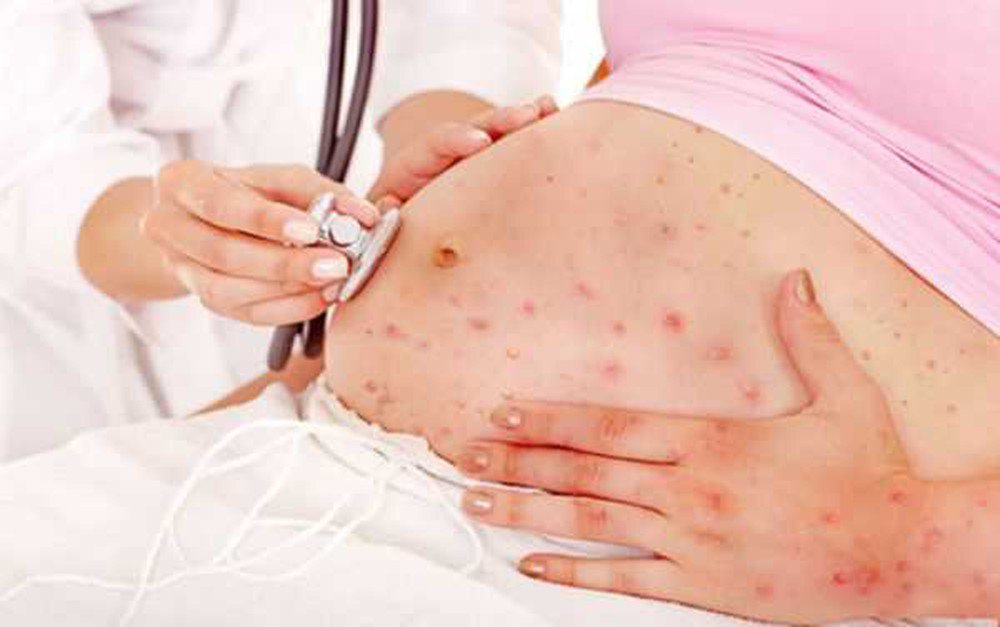 Sốt xuất huyết có thể gây nguy hiểm cho bà bầu