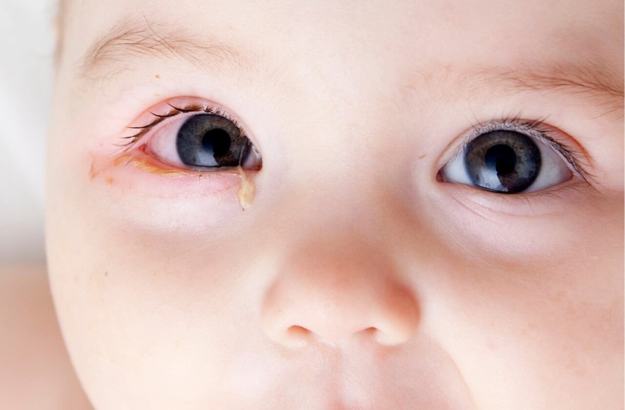 Nhỏ mắt bằng nước muối sinh lý cho trẻ giúp làm sạch và giảm vi khuẩn trong mắt