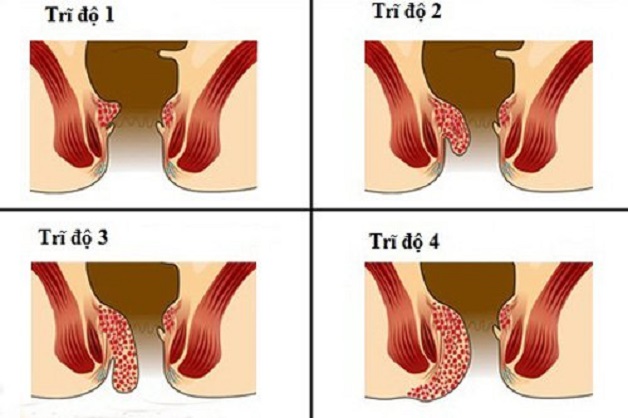 bệnh trĩ triệu chứng