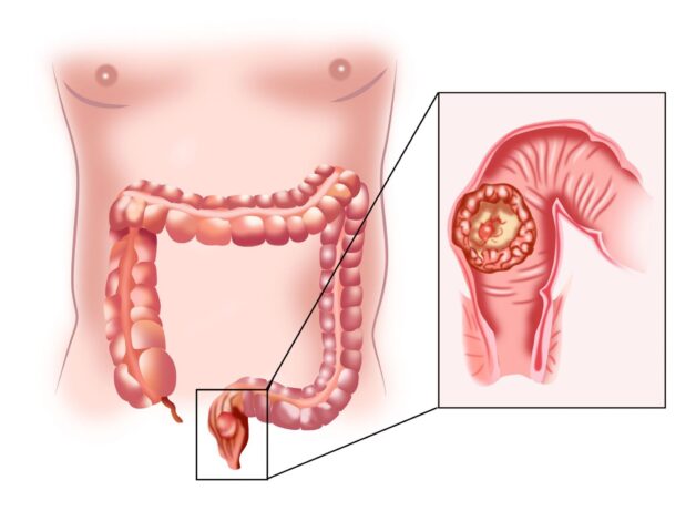 Các giai đoạn và phương pháp điều trị bệnh ung thư trực tràng