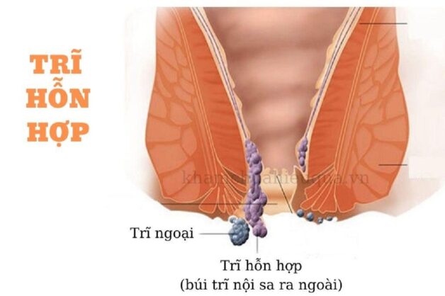 các dấu hiệu của bệnh trĩ
