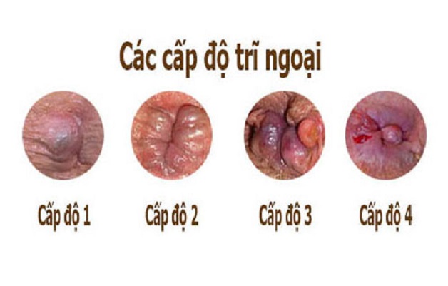 Các cấp độ trĩ ngoại