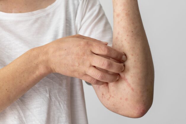 Bệnh nhân có thể bị phát ban da nghiêm trọng.