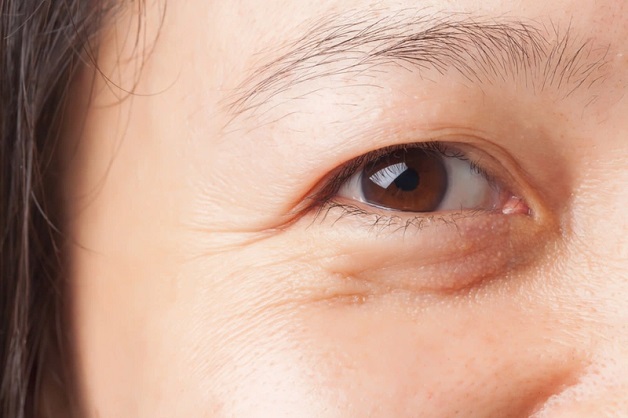 mắt bị sụp mí 1 bên sau khi ngủ dậy