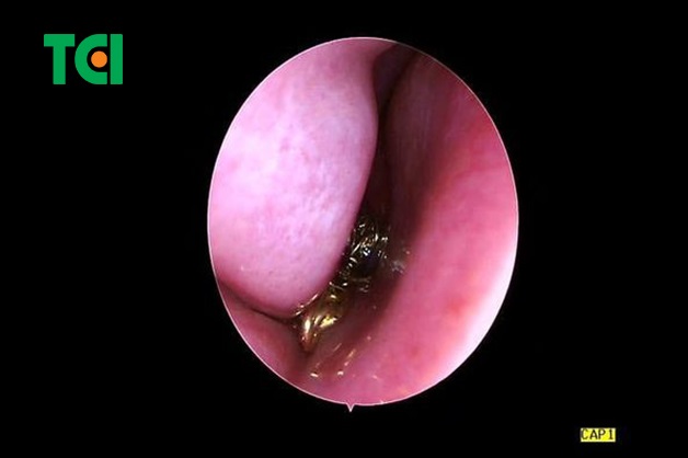 cách lấy dị vật ra khỏi mũi