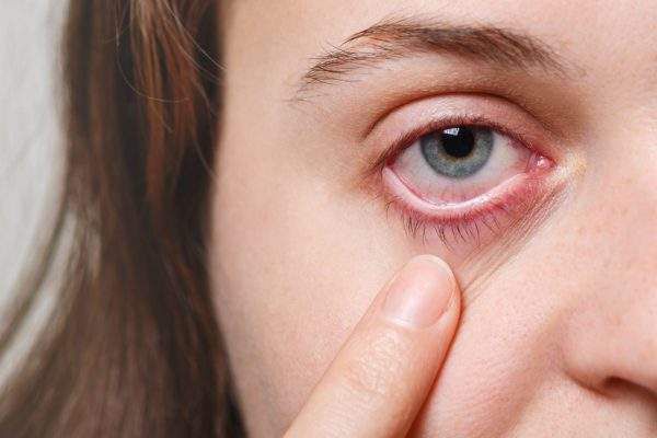 cách phòng ngừa đau mắt đỏ cho bà bầu
