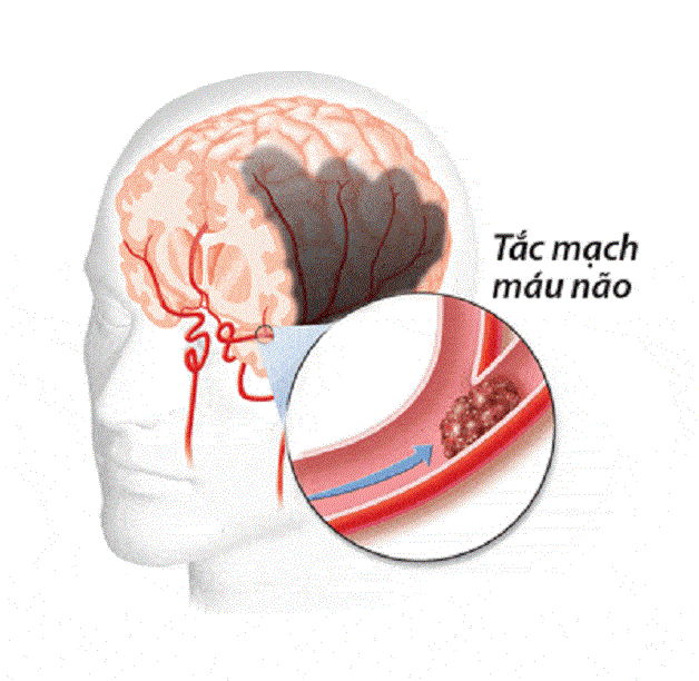 cơ chế đột quỵ