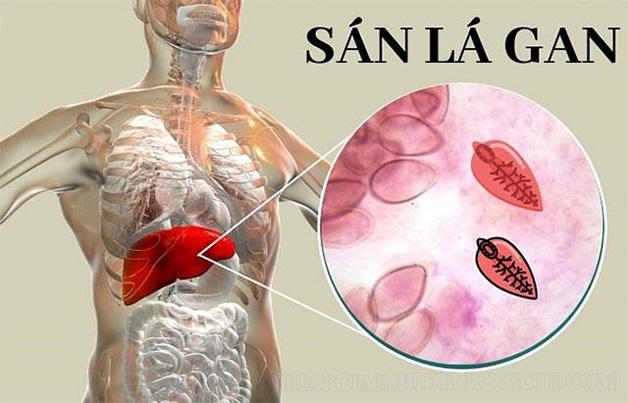 Đặc điểm gây bệnh của sán lá gan