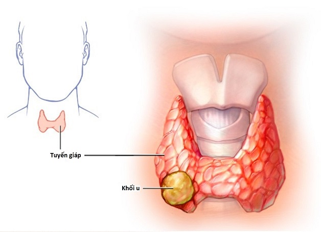 Tiên lượng sống của bệnh nhân ung thư tuyến giáp