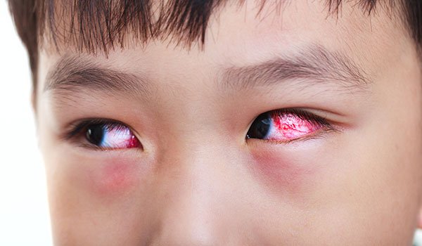 đau mắt đỏ có nên đi khám