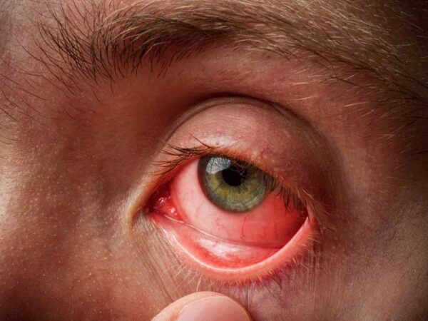Đau mắt đỏ lây như thế nào và cách điều trị