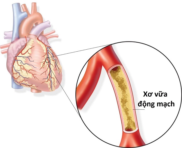 phương pháp điều trị thiếu máu cơ tim cục bộ 