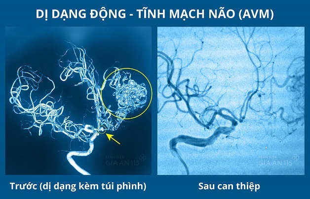 dự phòng đột quỵ nhờ tầm soát và xử trí túi phình mạch não sớm