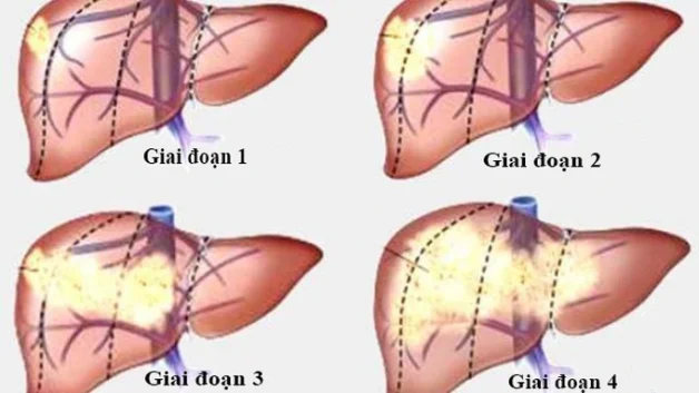 ung thư gan ở nam giới