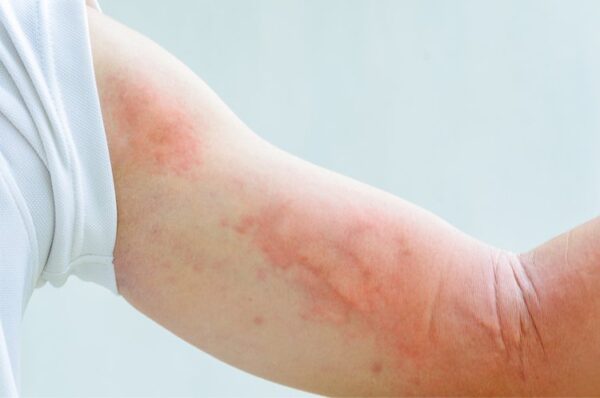 Giảm tiểu cầu khi bị sốt xuất huyết