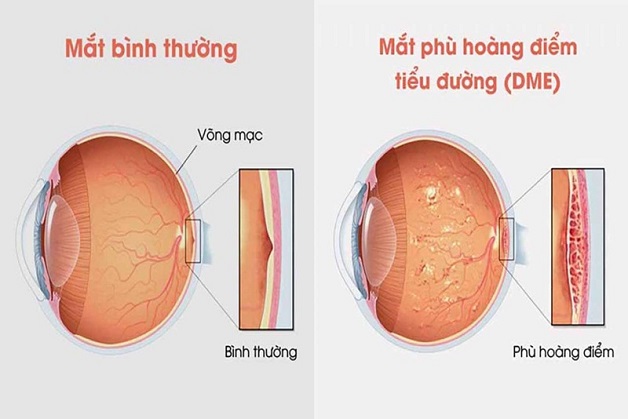Nguy cơ phù hoàng điểm ở người đái tháo đường