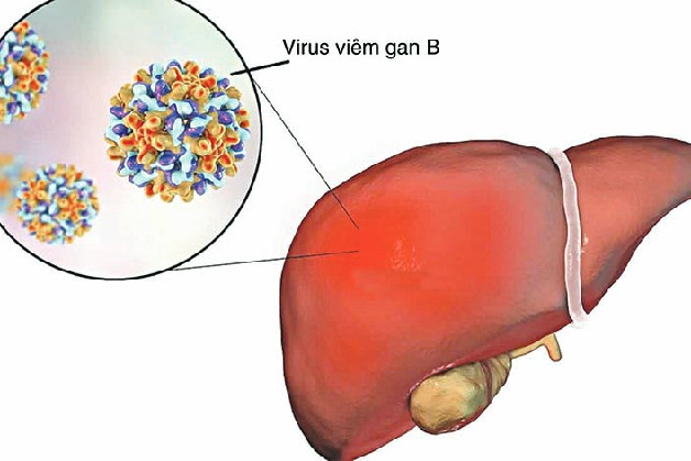 viêm gan b