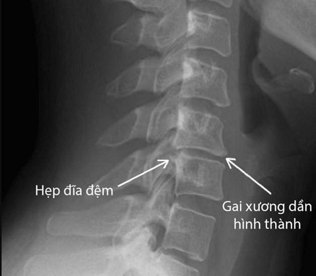 Nguyên nhân gây đau vai gáy do thoái hóa cột sống cổ